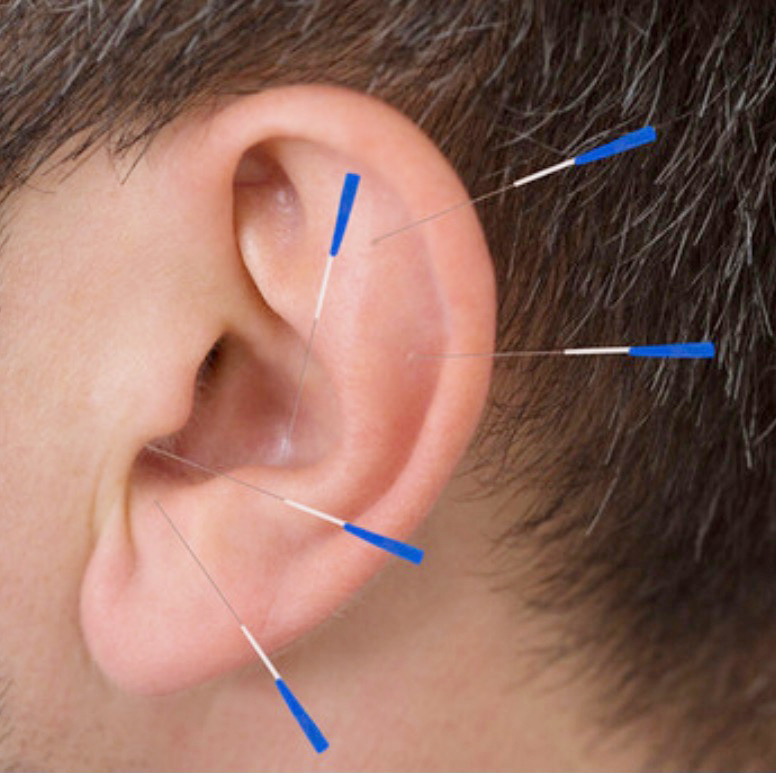 Auriculotherapy Ear Acupressure Hsing Healthcare Clinic 